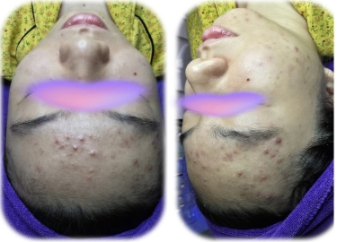 CHĂM SÓC DA MỤN THÂM